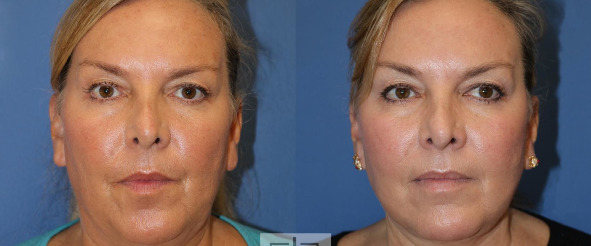 The Secret to Long-Lasting Facelift Results