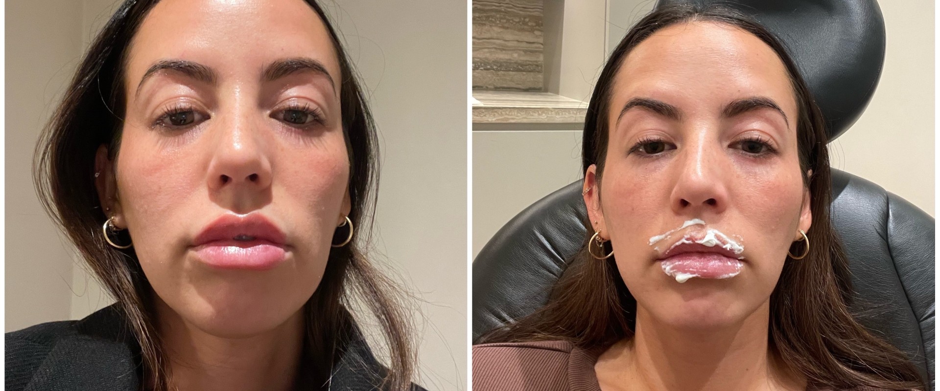 Do fillers ever completely go away?