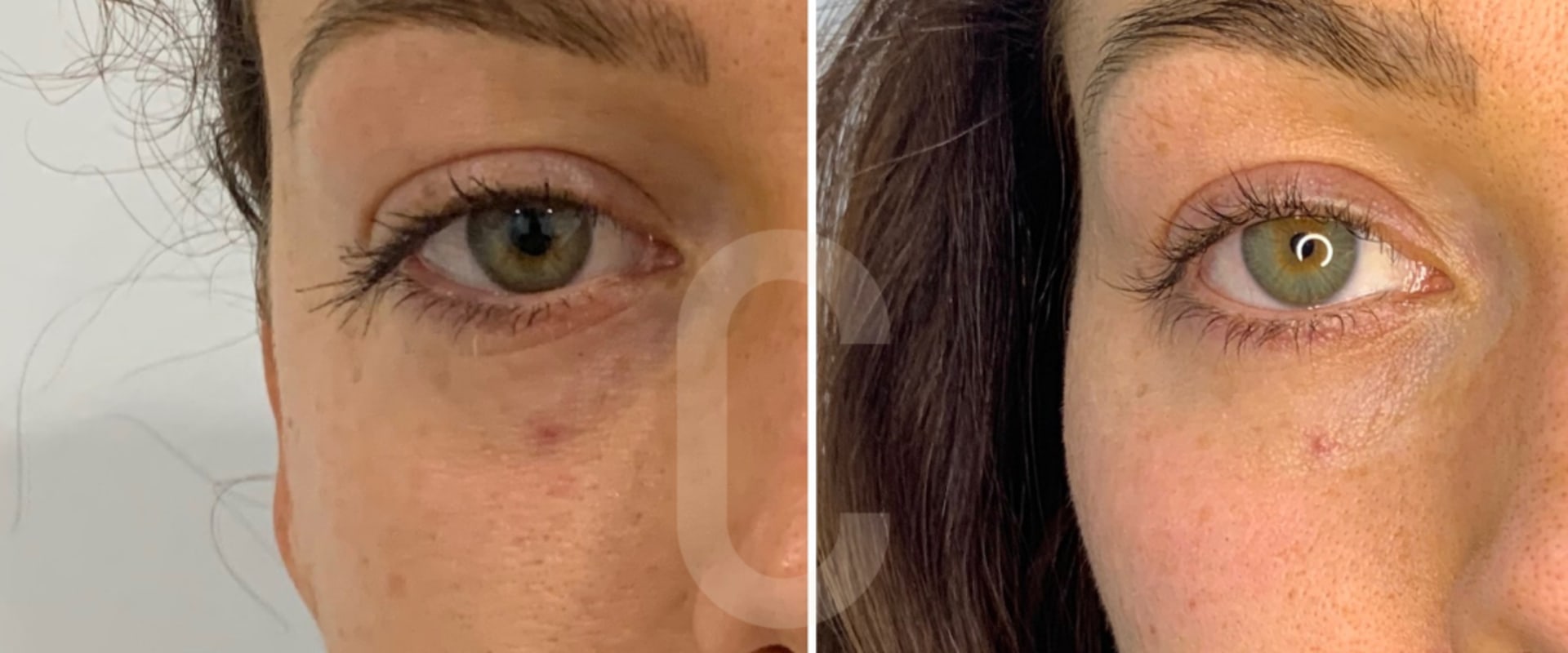 How to make fillers go down quicker?