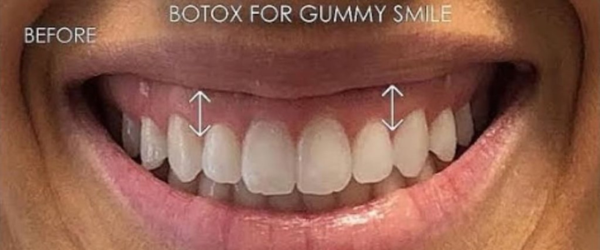 Your Complete Guide to Gummy Smile Treatment: Everything London Patients Need to Know