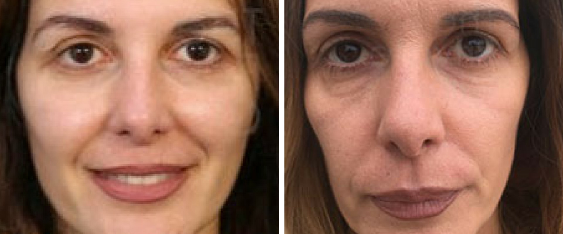 What is the newest non surgical facelift procedure?