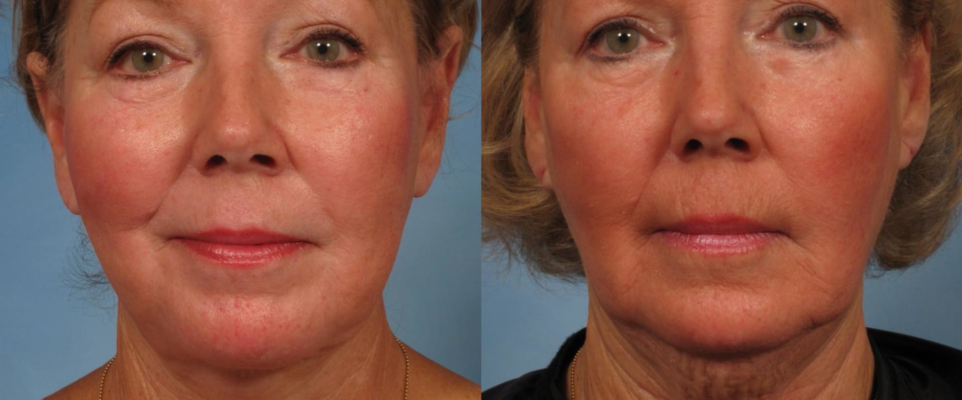 Should i get a facelift at 50?