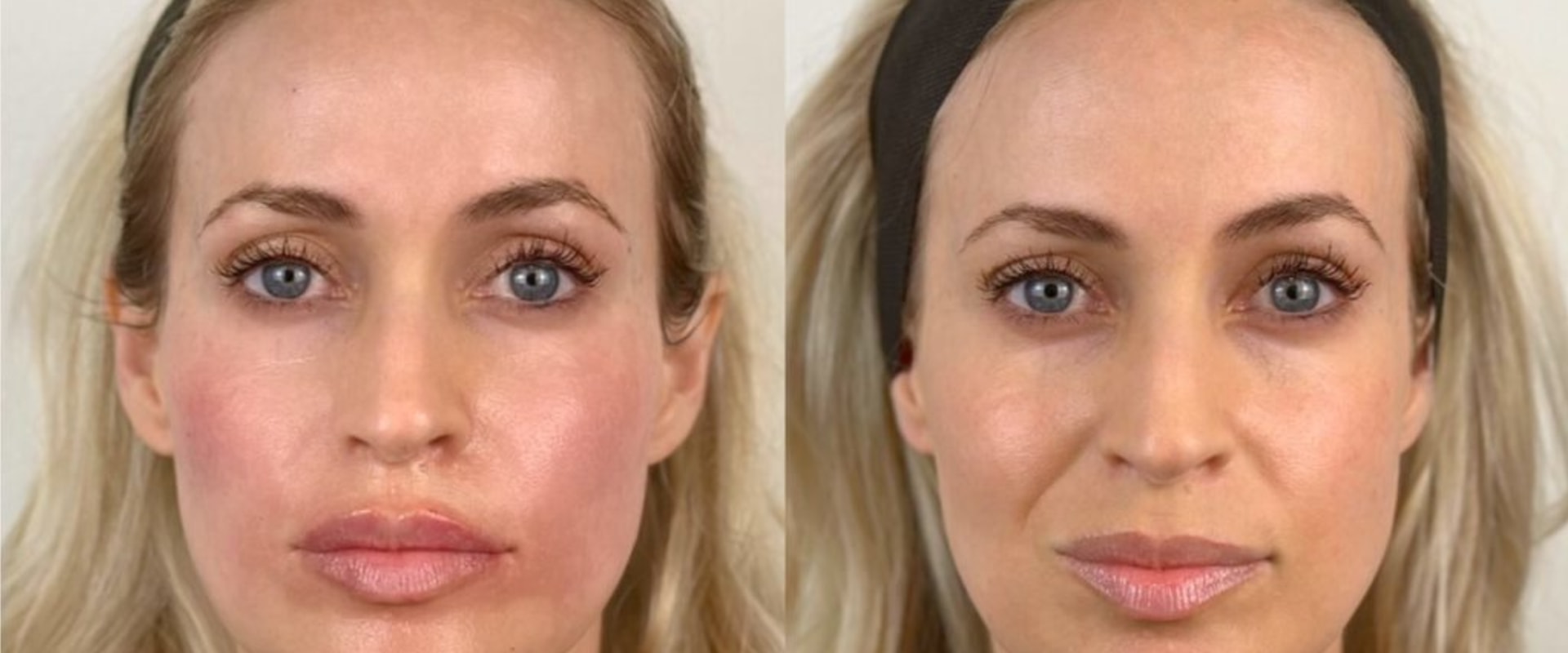 How long can filler last in cheeks?