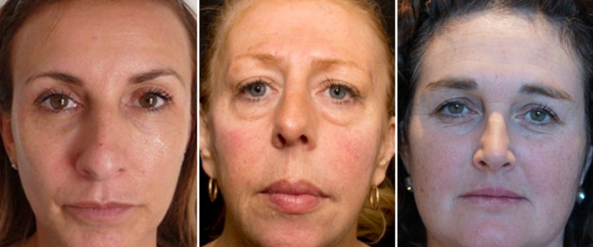 Is it ok to get fillers every year?