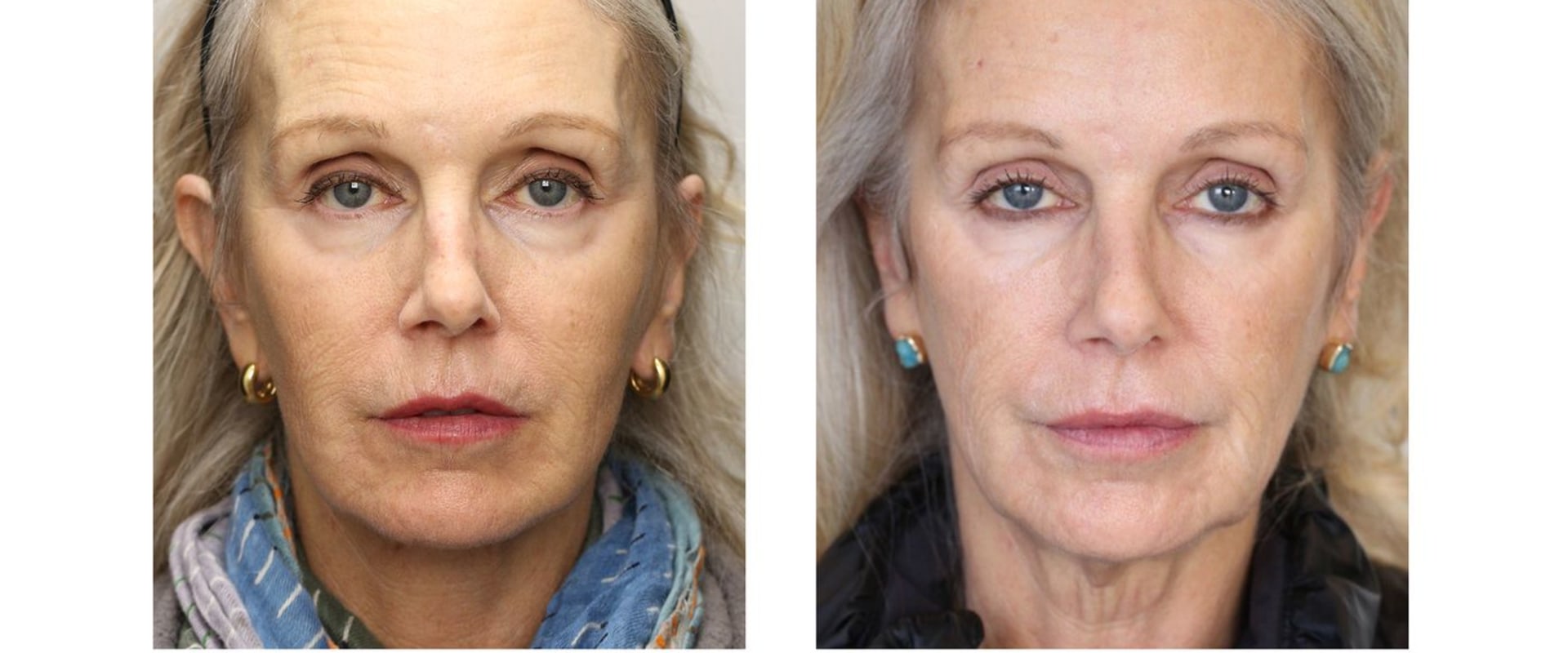 Can you get a facelift multiple times?