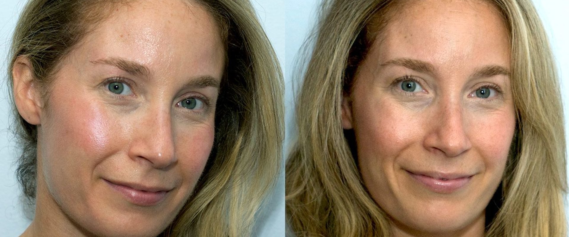Do wrinkle fillers really work?