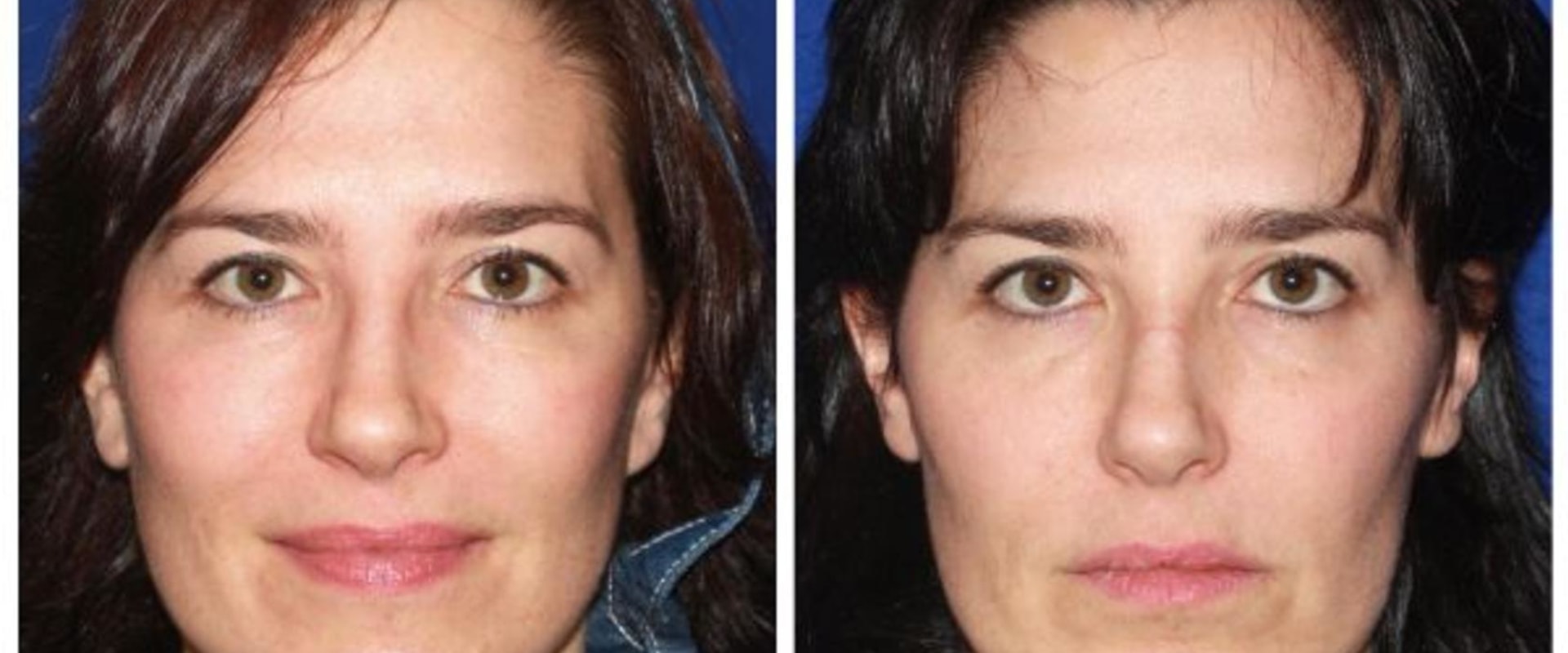 The Truth About the Longevity of a Mini Facelift: An Expert's Perspective