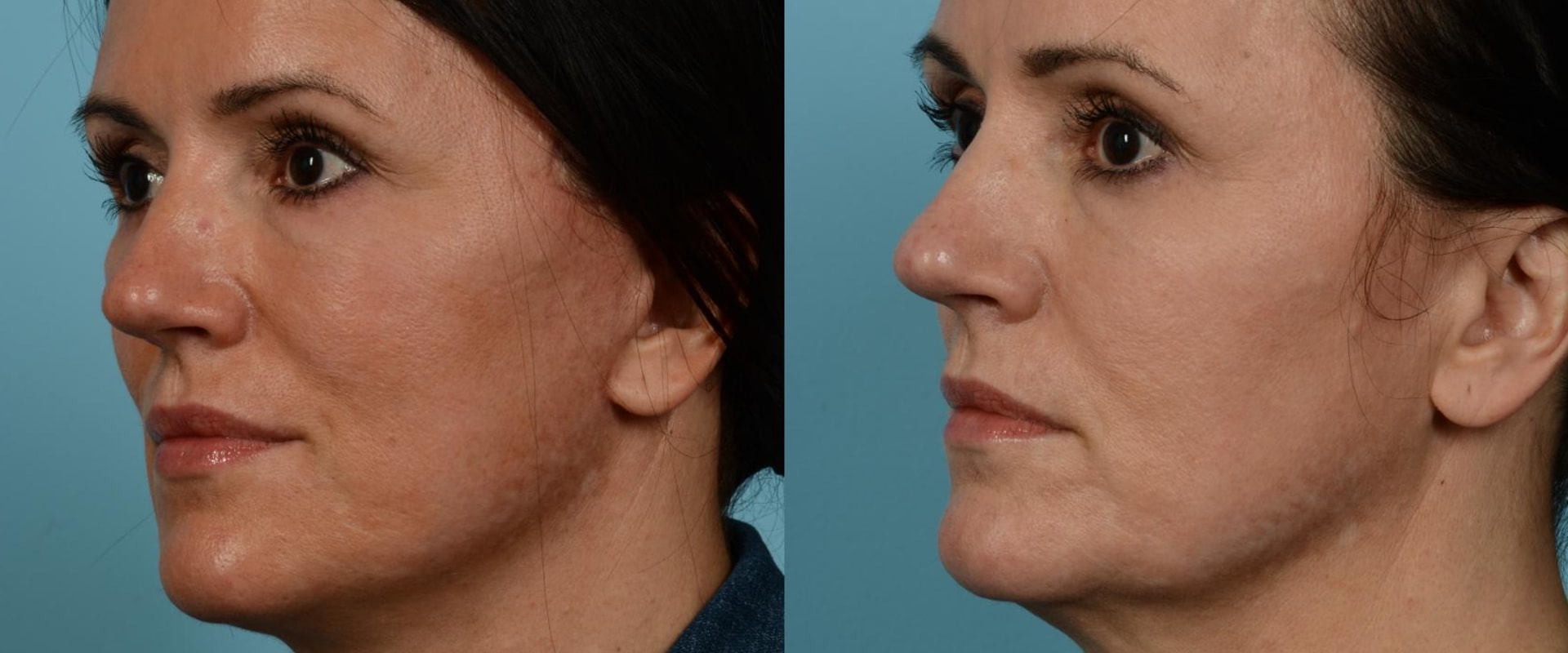 What age is good for mini facelift?