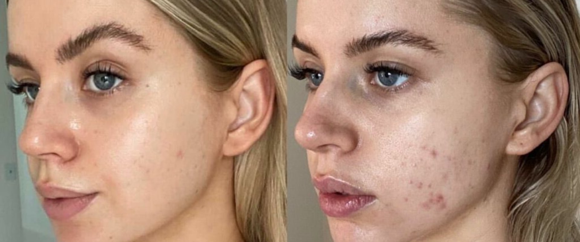 What is the most effective face lifting treatment?