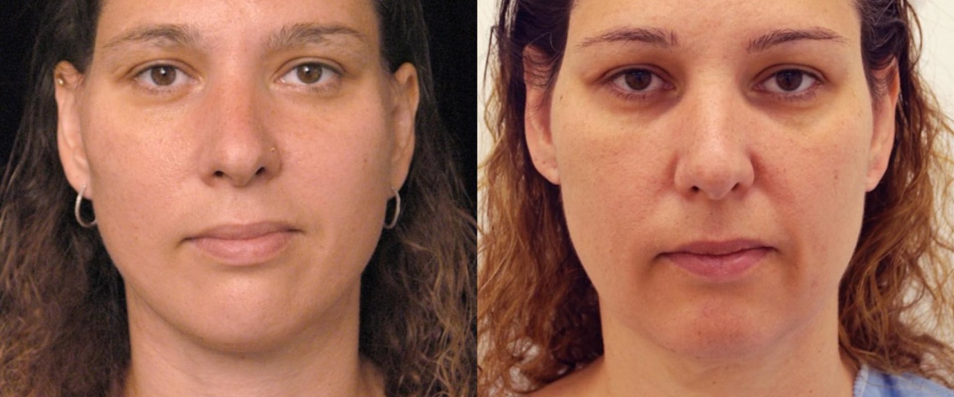 Do facelifts look unnatural?