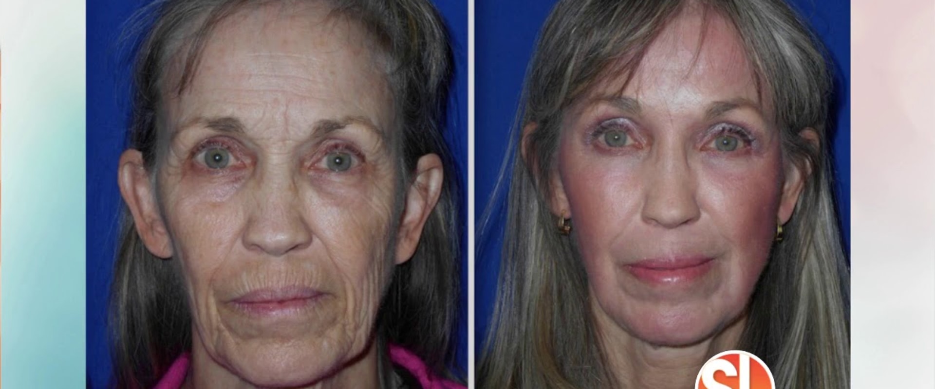 The Power of Facelifts: How Plastic Surgery Can Make You Look 20 Years Younger