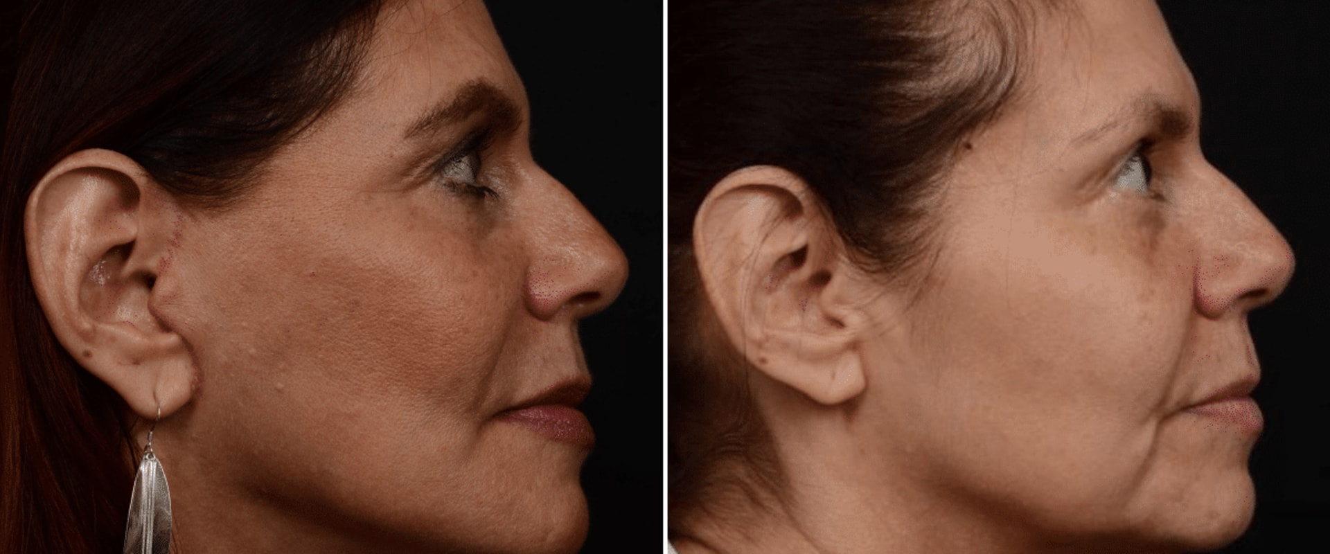 What is the success rate of a facelift?