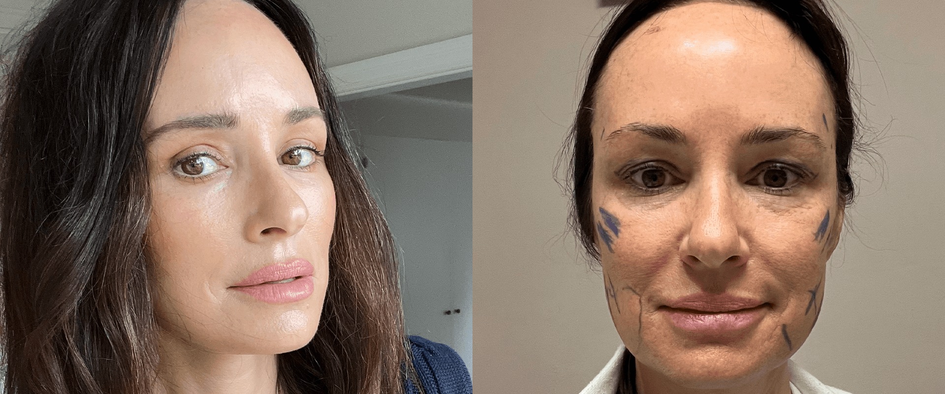 Are face lifts obvious?