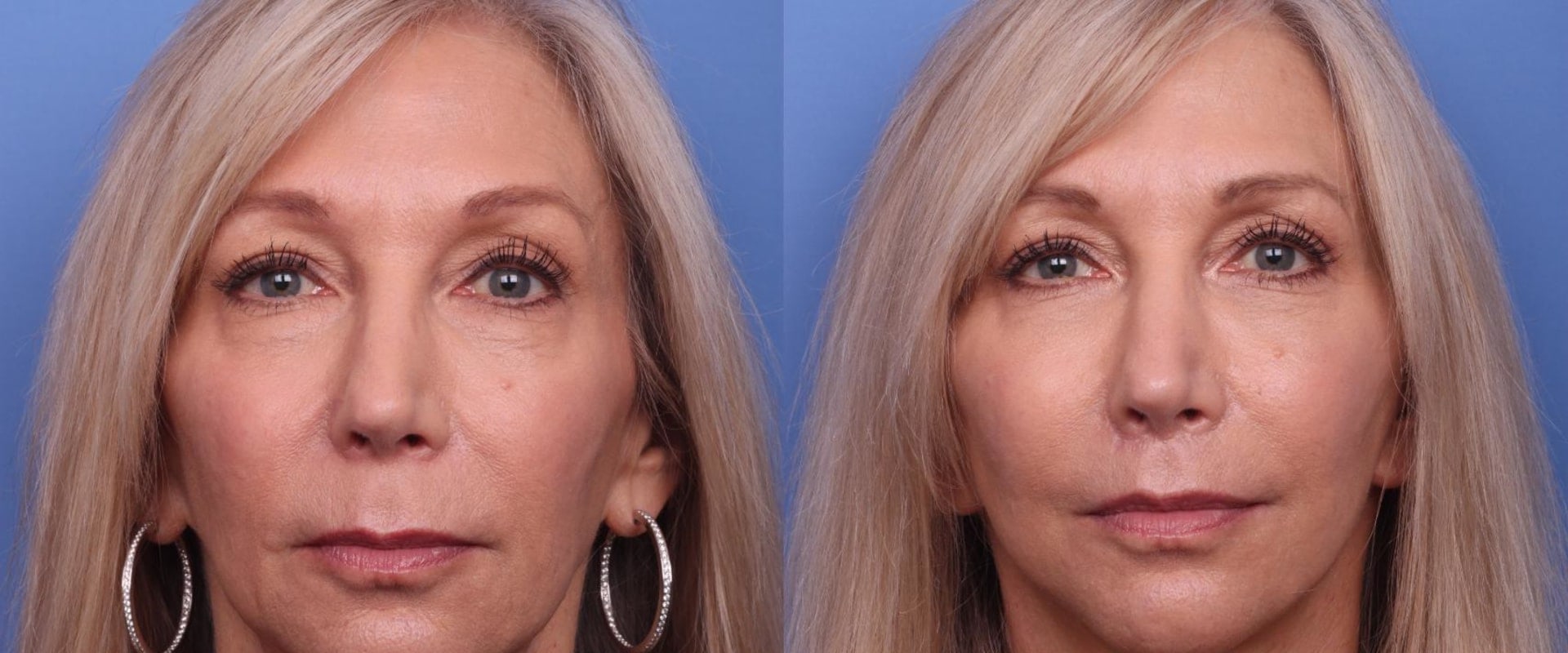 The Truth About Facelifts: Debunking the Myths and Revealing the Facts