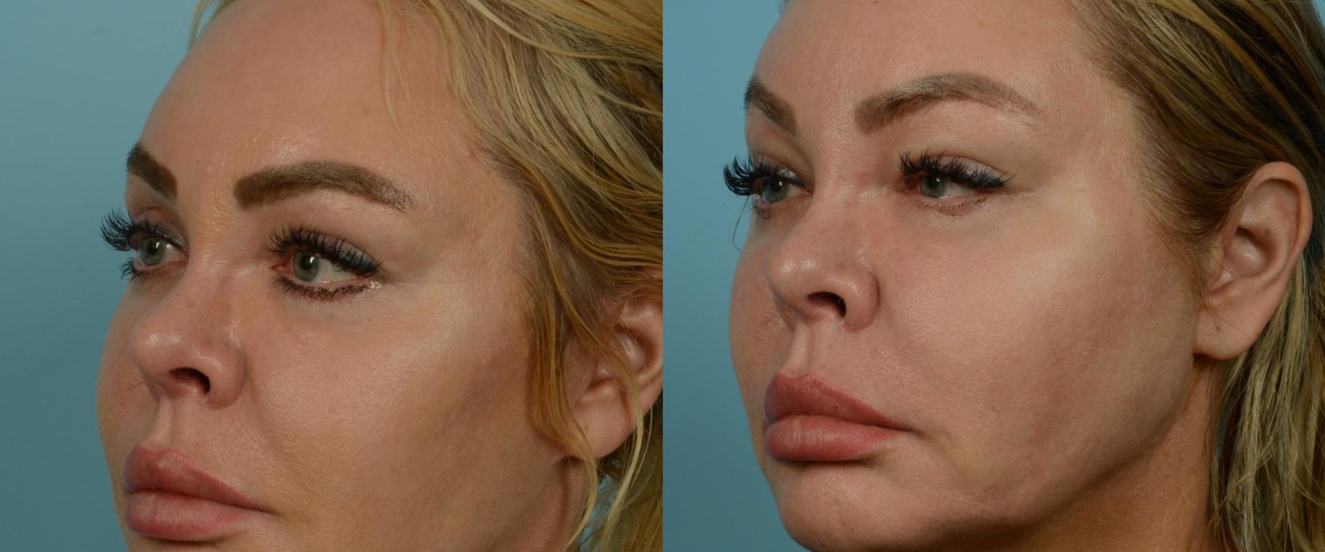Do i really need a facelift?