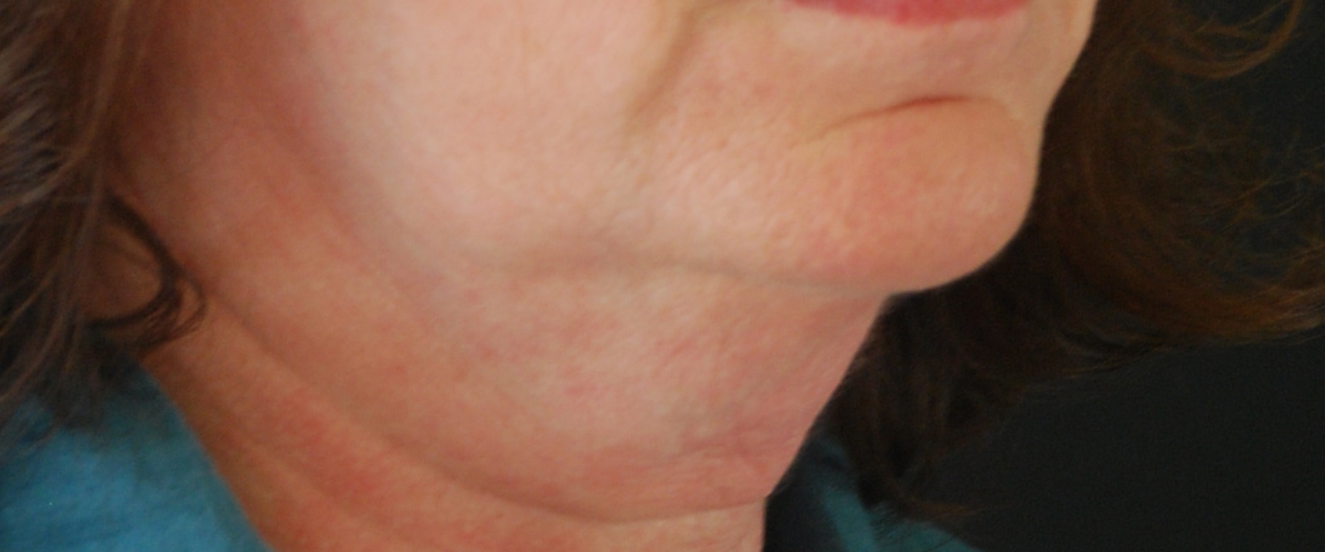 The Ideal Age for a Facelift: Expert Insights