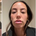 Do fillers ever completely go away?