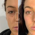 How to make fillers go down quicker?