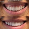 Your Complete Guide to Gummy Smile Treatment: Everything London Patients Need to Know