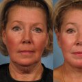 Should i get a facelift at 50?