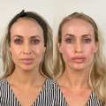 How long can filler last in cheeks?