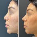 What dissolves fillers faster?