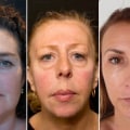 Is it ok to get fillers every year?
