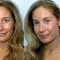 Do wrinkle fillers really work?