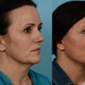 What age is good for mini facelift?