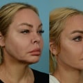 Do facelifts ever look good?
