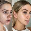 What is the most effective face lifting treatment?