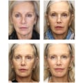 Can a facelift make you look 15 years younger?