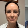 Are face lifts obvious?