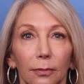 The Truth About Facelifts: Debunking the Myths and Revealing the Facts