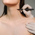 Nefertiti Neck Lift: Revolutionary Non-Surgical Neck Rejuvenation