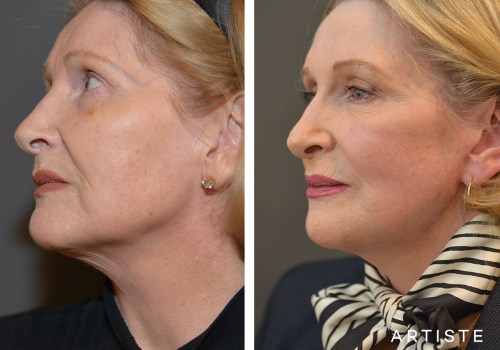 How Many Years Younger Do You Look After a Facelift?