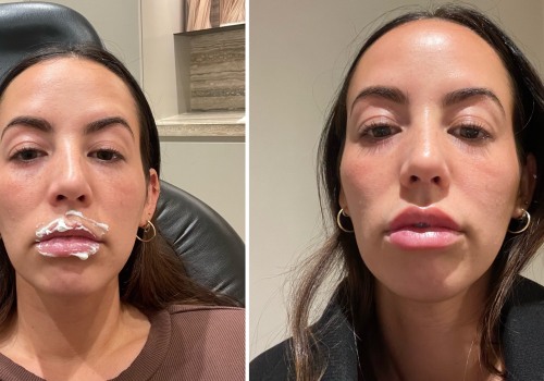 Do fillers ever completely go away?