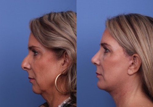 When does a facelift look its best?