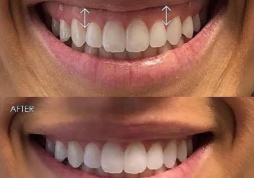 Your Complete Guide to Gummy Smile Treatment: Everything London Patients Need to Know