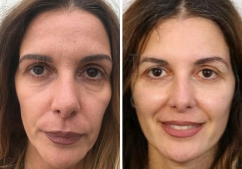 What is the newest non surgical facelift procedure?
