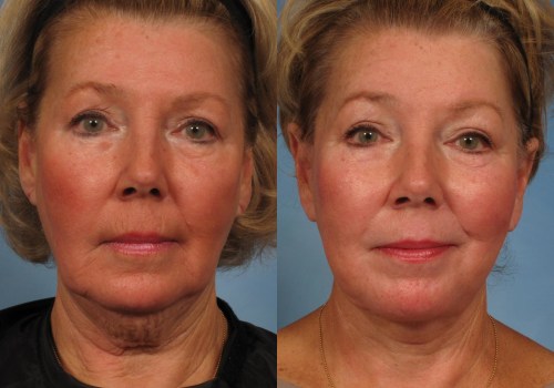 Should i get a facelift at 50?