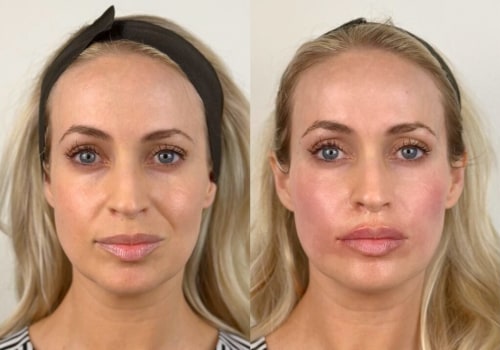 How long can filler last in cheeks?
