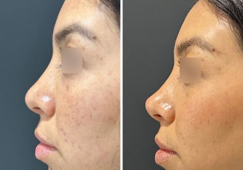 What dissolves fillers faster?