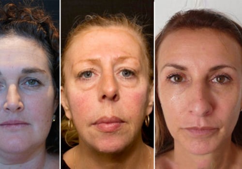 Is it ok to get fillers every year?
