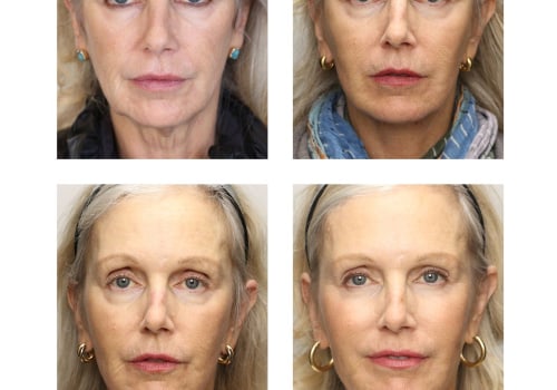 Can you get a facelift multiple times?