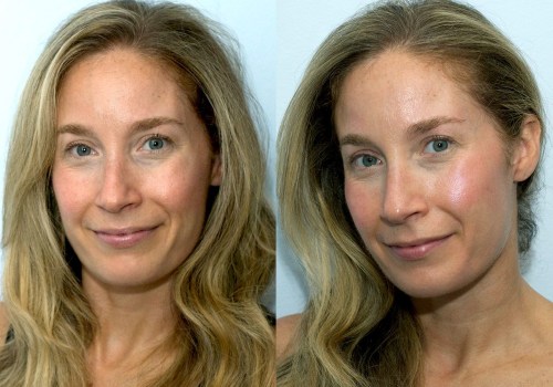 Do wrinkle fillers really work?
