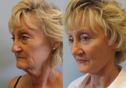How Much Does a Facelift Cost in Tampa, Florida?