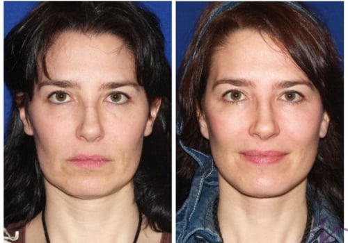 What are the Pros and Cons of a Mini Facelift?
