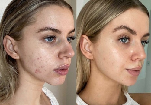 What is the most effective face lifting treatment?