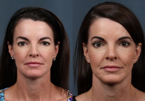 How Many Years Does a Facelift Take Off Your Age?